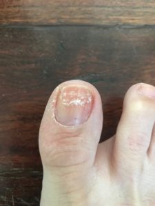HOW TO: Fix Nails Damaged by Pedicures - The Well-Heeled