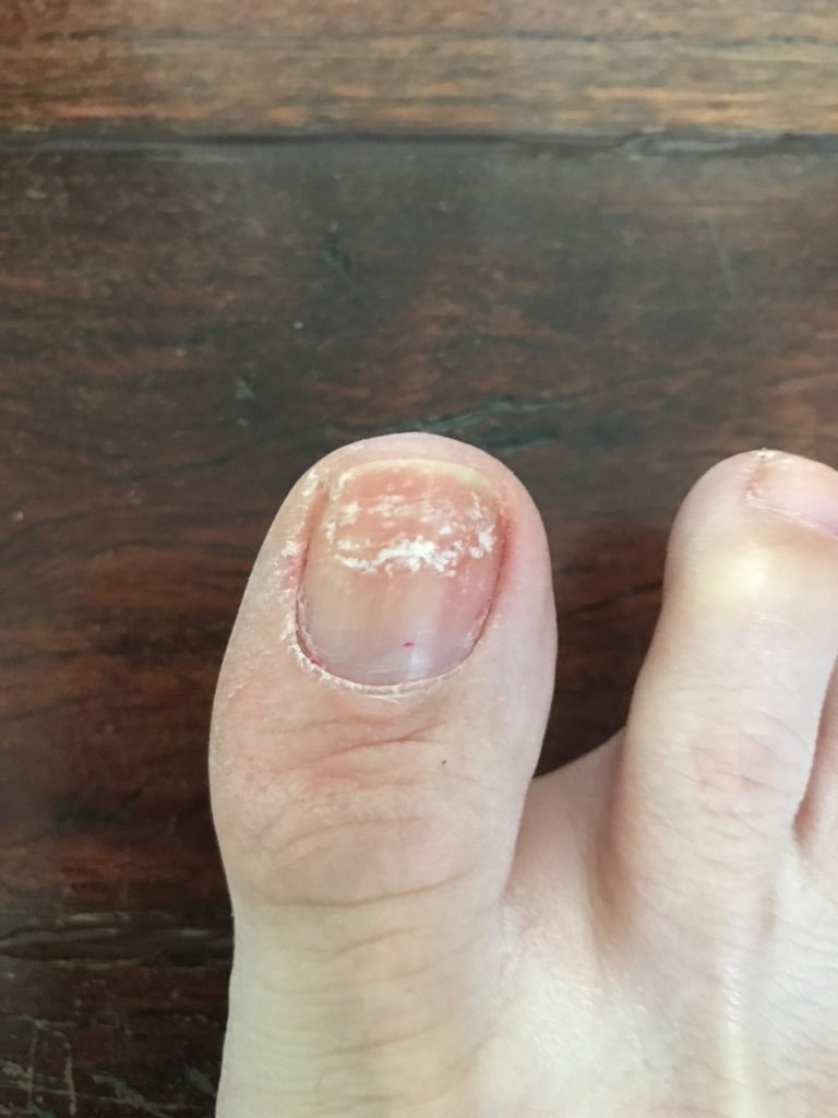 HOW TO Fix Nails Damaged By Pedicures The Well Heeled